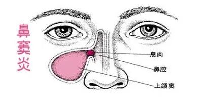 鼻窦炎的发生知道多少？现在了解还不晚(图5)