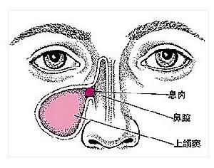 鼻息肉是怎么长出来的呢？你知道多少？(图2)