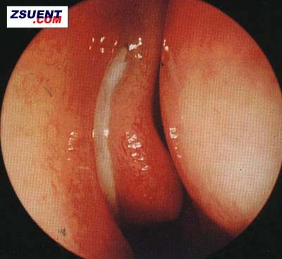 鼻窦炎(图1)