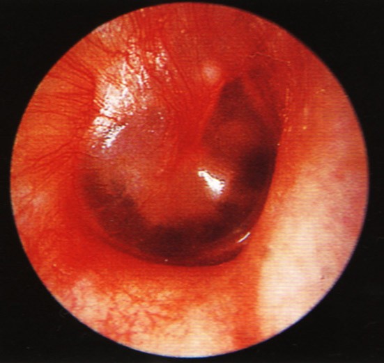 急性中耳炎(图1)